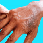 Leprosy Update: 331 Patients Under Treatment in Amravati District