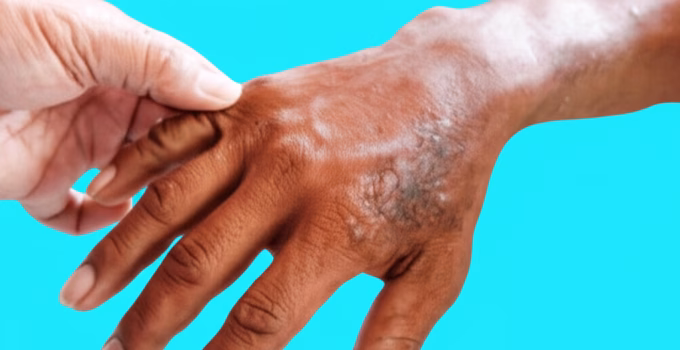 Leprosy Update: 331 Patients Under Treatment in Amravati District