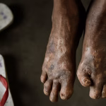 Leprosy Detection Drive Shock! 405 Cases in Chandrapur - Are You Safe?