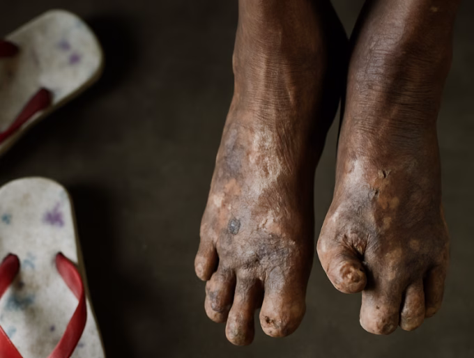 Leprosy Detection Drive Shock! 405 Cases in Chandrapur - Are You Safe?