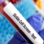 Arunodaya sickle cell campaign, Nagpur sickle cell screening